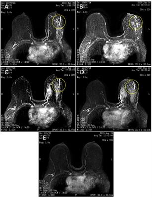 Chemotherapy combined with endocrine neoadjuvant therapy for hormone receptor-positive local advanced breast cancer: a case report and literature review